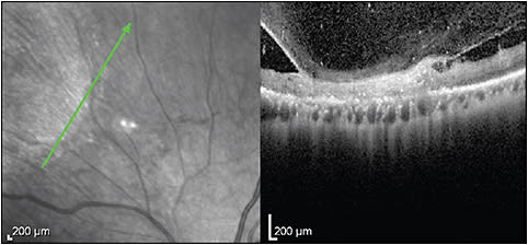 Figure 6. Cytomegalovirus retinitis. Images (Heidelberg Spectralis) show full-thickness retinal thickening, hyperreflectivity, and loss of identifiable layers.