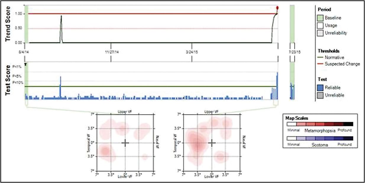 Figure 4. The Foreseehome report shows location, test, and trend score of metamorphopsia at the time of alert and confirmed conversion. Image courtesy Byron Ladd, MD