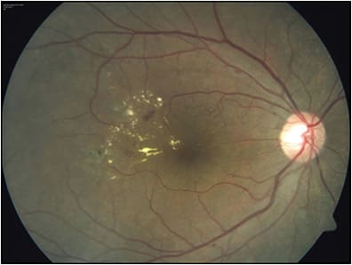 Figure 1. This eye is an ideal candidate for focal laser treatment. Note the absence of foveal edema but presence of temporal clinically significant diabetic macular edema and microaneurysms within circinate rings. Visual acuity is 20/20.