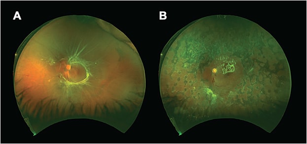 Figure 2. Widefield fundus photography (Optos) displaying a tractional retinal detachment (A). Widefield fundus photography displaying postoperative appearance after surgical repair with silicone oil and application of endolaser in the retinal periphery (B). Images courtesy of Dr. Luis Haddock.