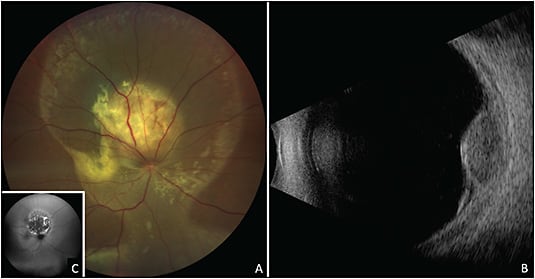 Figure 5. A 44-year-old female patient presented with history of visual field loss in the right eye for 4 months