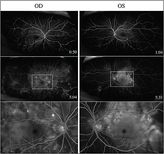 Figure 2. Widefield fluorescein angiography imaging (Optos) of active Vogt-Koyanagi-Harada disease. Both right (OD) and left (OS) eyes displayed normal filling in the mid-phase (top) but showed extensive choroidal and subretinal leakage with pooling within the serous RDs in the late phase (middle). Macula images from late phase are expanded to highlight multifocal pinpoint areas of fluorescein leakage as well as pooling of dye within the serous RDs (bottom). Images were obtained from patient prior to initiation of therapy.