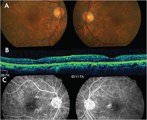 Figure 6. This 71-year-old male was referred with nyctalopia and with subacute blurring of central vision bilaterally. VA measured 20/50 RE and 20/40 LE and fundus examination revealed parafoveal RPE mottling (Figure A). Macular OCT identified a generalized irregularity of the ellipsoid zone (Figure B). FA revealed staining of the RPE mottling only (Figure C). ERG was consistent with rod &gt; cone dysfunction.