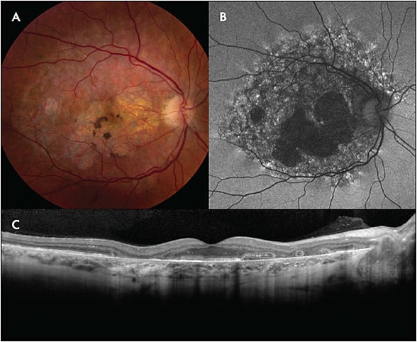 Figure 1. Fundus imaging of a patient with fairly advanced atrophic disease in the setting of chronic pentosan polysulfate exposure. Color fundus photography of the right eye demonstrates prominent paracentral atrophy of the retinal pigment epithelium surrounded by subtle pale yellow deposits (A). Fundus autofluorescence imaging demonstrates a well-defined region in the posterior pole with densely packed hyperautofluorescent and hypoautofluorescent spots. There is hypoautofluorescence associated with retinal pigment epithelium atrophy encroaching on the foveal center (B). Optical coherence tomography imaging demonstrates paracentral atrophy with outer retinal tubulations (C).