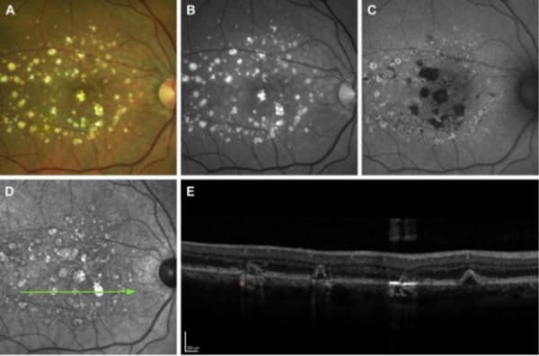 Figure 1. Multimodal imaging showing refractile drusen and hyperreflective crystalline deposits on (A) color fundus photograph, (B) red-free photograph, (C) fundus autofluorescence, (D) near-infrared image, and (E) OCT scan.