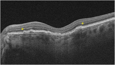 Figure 1. Optical coherence tomography of a shallow, irregular overlying RPE layer with nonhomogenous reflectivity adjacent to a focal area of choroidal excavation (asterisks).