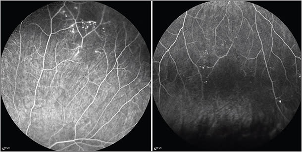 Figure 2. Left eye of a 40-year-old female after 5 years&amp;#x2019; follow-up showing areas of peripheral capillary nonperfusion and microaneurysms.