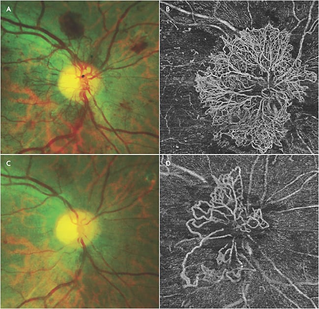 Figure 5. Fundus photo of neovascularization of the disc (A). Swept-source optical coherence tomography angiography (Plex Elite 9000; Carl Zeiss Meditec) showing dramatic neovascularization of the disc in the same eye (B). Fundus photo showing regression of neovascularization of the disc after panretinal photocoagulation and anti-VEGF therapy (C). Swept-source optical coherence tomography angiography showing some regression but persistence of neovascularization of the disc in the same eye (D).