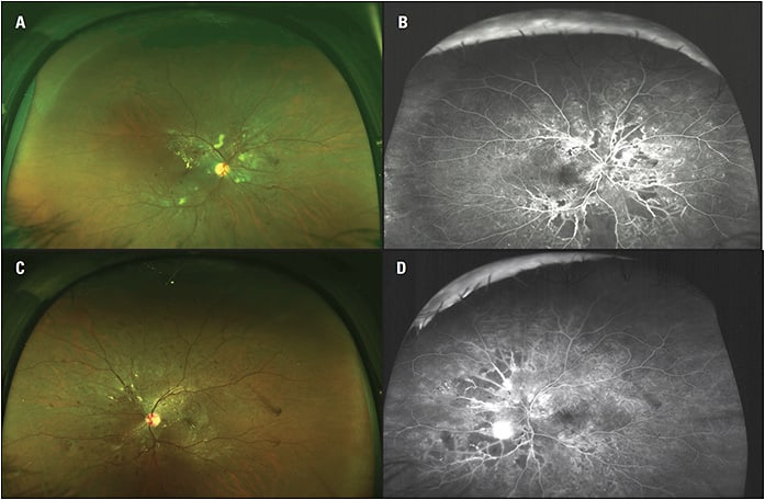 Figure 2. The peripheral retinal exam is critical to predicting which patients are likely to experience progression of diabetic retinopathy. In the right (A,B) and left (C,D) eyes of this patient, widefield color fundus photographs and widefield fluorescein angiography show proliferative diabetic retinopathy with ischemia, capillary dropout, and neovascularization elsewhere beyond the posterior pole.
Images courtesy of Arshad Khanani MD, MA