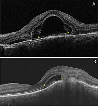 Figure 4. Fluid dissecting through the bacillary layer (cone and rod inner and outer segments) resulting in a dome-shaped intraretinal separation in these cases with multifocal choroiditis (A) and choroidal granuloma (B).