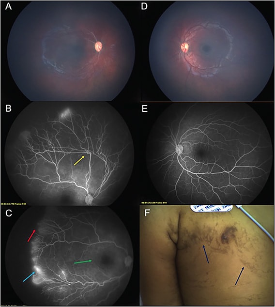 Figure 5. A 16-month-old female with incontinentia pigmenti. Contact fundus photography of the right eye shows nonspecific vascular changes and a blunted foveal reflex (A). Fluorescein angiogram of the right eye reveals vessel bending (yellow arrow), peripheral leakage (blue arrow), enlarged foveal avascular zone (green arrow), and peripheral nonperfusion (red arrow) (B, C). Fundus photography and FA of the left eye are unremarkable (D, E). External photography of the chest in this child reveals hyperpigmented, brown linear skin lesions (blue arrow) (F).