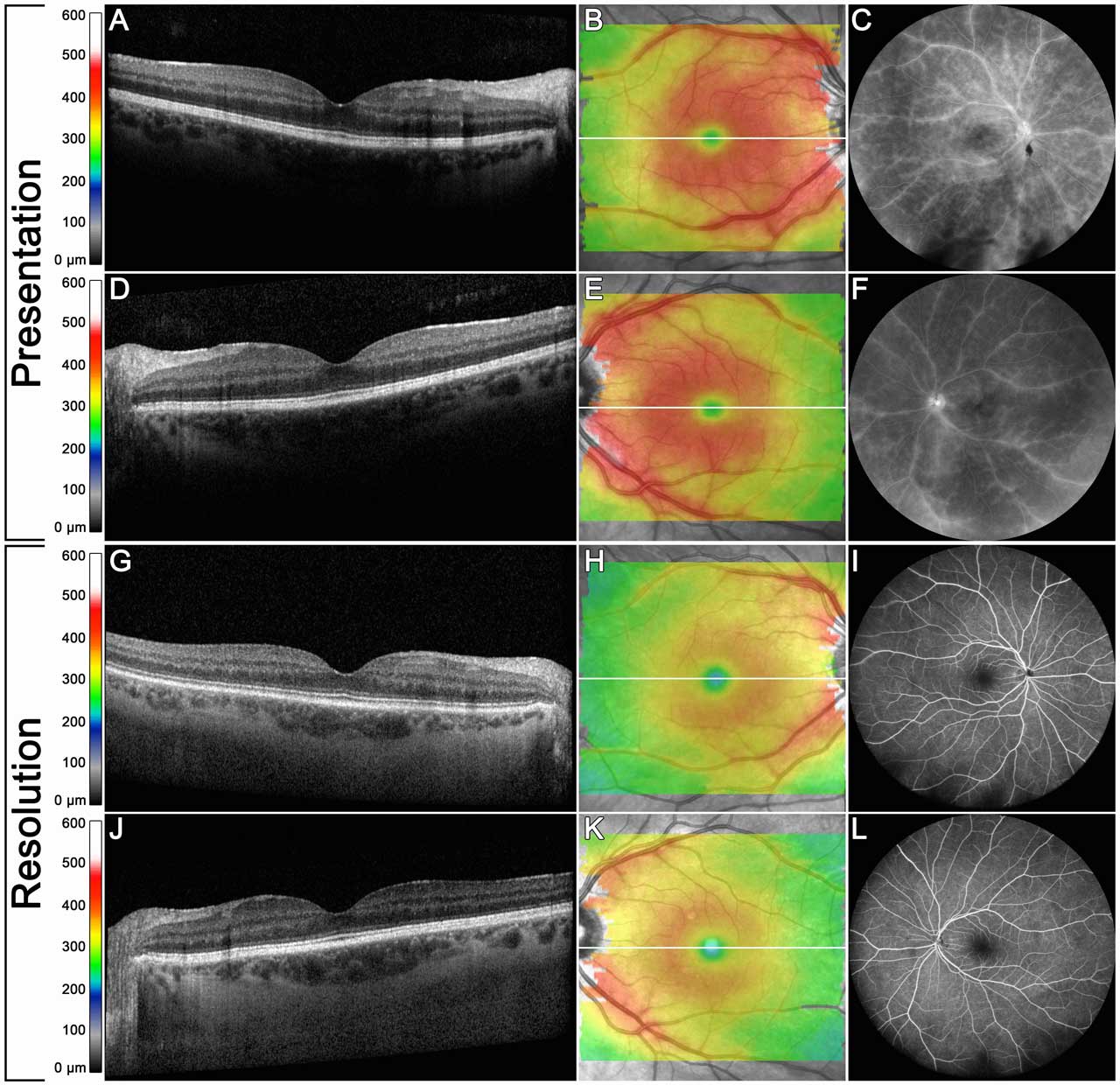 Figure 1. A 41-year-old female with intermediate uveitis and retinal vasculitis in both eyes. On presentation, optical coherence tomography (OCT) B-scans show no evidence of cystoid macular edema in either eye (A, D). Retinal thickness maps demonstrate macular and perivascular thickening in both eyes (B, E). Late frames on fluorescein angiography demonstrate diffuse small and large vessel vasculitis and optic nerve hyperfluorescence (C, F). After treatment, OCT B-scans show no significant change (G, J). Retinal thickness maps demonstrated overall significant reduction of macular and perivascular thickness (H, K). Fluorescein angiography shows resolution of vasculitis (I, L).