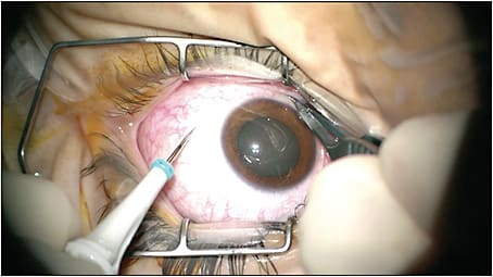 Figure 1. Insertion of the trochar–cannula system prior to performing anterior-segment surgery facilitates placement and minimizes inadvertent opening of the corneal incisions during placement.