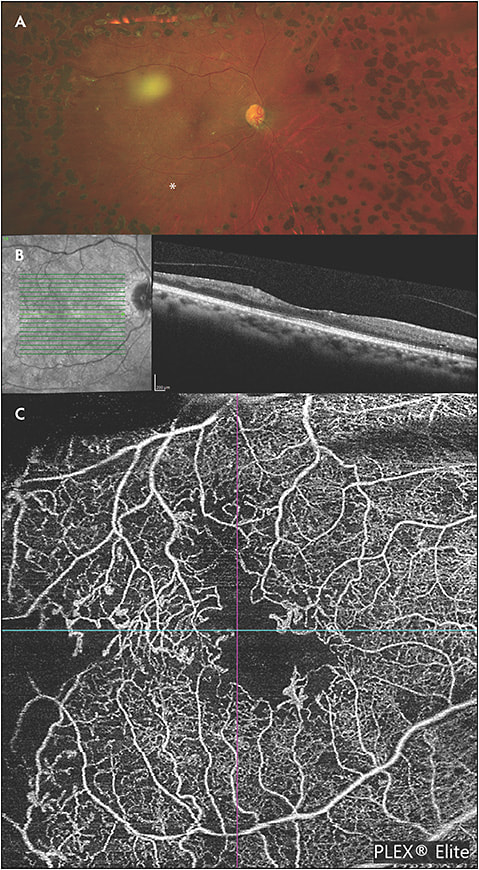 Figure 2. A 61-year-old black female with treated proliferative diabetic retinopathy. Optos fundus image of the right eye demonstrates panretinal photocoagulation. There is temporal macular sclerosis of the vessels and inferior neovascularization elsewhere (asterisk) that is mature and persistent (A). Spectral-domain OCT of the right macula demonstrates inner retinal atrophy with disorganization of the retinal inner layers present through the central foveal concavity (B). Plex Elite OCT angiography imaging (Zeiss) at the level of the superficial capillary plexus demonstrates corresponding enlargement of the foveal avascular zone (C).