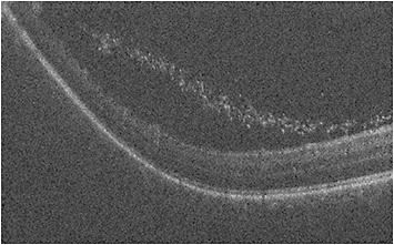 Figure 2. Handheld OCT (Envisu; Leica Microsystems) in zone 2 showing immaturely vascularized retina in the periphery as well as stage 3 retinopathy of prematurity with extravascular fibrous proliferation and “popcorn” lesions in vitreous cavity during exam under anesthesia of an infant with retinopathy of prematurity (same patient as Figure 1A and 1B).