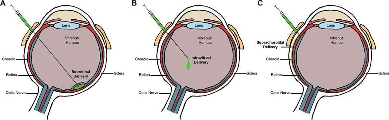 Figure 4.  Routes of ocular gene therapy administration: subretinal delivery (A); intravitreal delivery (B); suprachoroidal delivery (C). From Guimaraes TAC, Georgiou M, Bainbridge JWB, Michaelides M. Br J Ophthalmol. 2021;105(2):151-157. Licensed for reuse under the Creative Commons Attribution 4.0 Unported license.