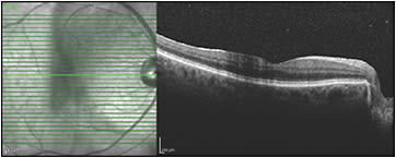 Figure 2. Optical coherence tomography shows signal attenuation caused by a vitreous veil on the central macula. This could be quantified.