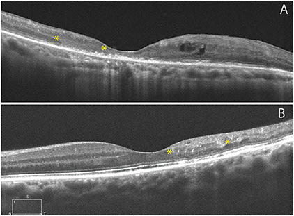 Figure 3. The loss of distinguishable boundaries between retinal layers is evident in these cases of ischemic central retinal vein occlusion (A, asterisks) and branch retinal vein occlusion (B, asterisks).