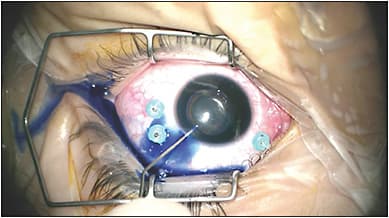 Figure 3. Staining of the anterior capsule with 0.025% trypan blue solution allows easier visualization, especially in complex cases with inadequate red reflex.