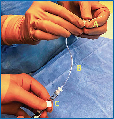 Figure 1. Setup of the injection apparatus includes a 41-gauge subretinal injection cannula (A) connected by a polyvinyl chloride extension tube (B) to the disposable syringe containing 0.8 mL of voretigene neparvovec-rzyl (C).&#xA;Courtesy of Christina Y. Weng, MD, MBA