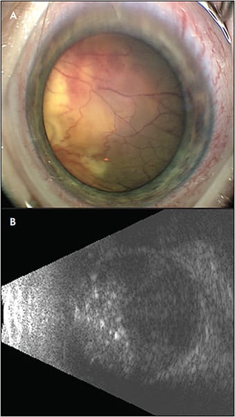 Figure 1. A 24-month-old patient presented with leukocoria. Note a whitish-yellow mass causing total retinal detachment (A).