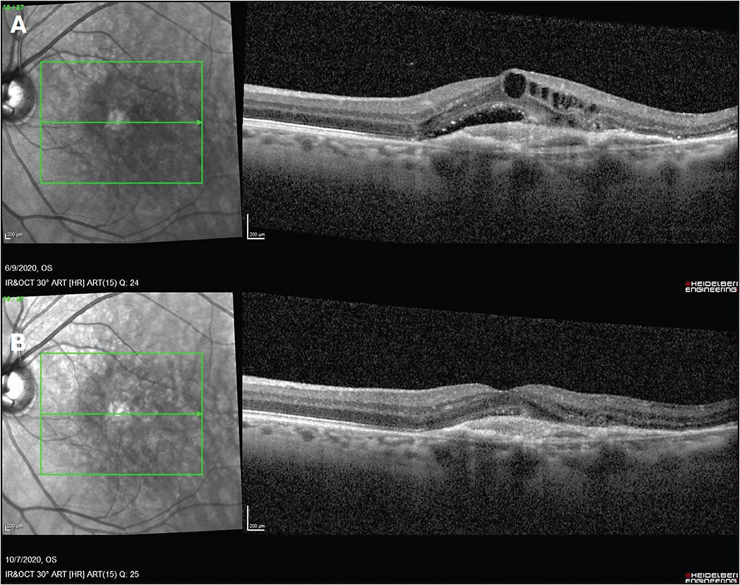 Figure 2. Persistent subretinal and intraretinal edema after 6 monthly injections of ranibizumab (A). The patient received intravitreal aflibercept injections every 4 weeks for 3 injections, with significant improvement in subretinal and intraretinal fluid (B).