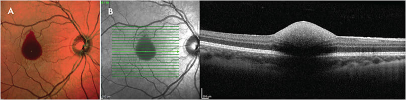 Figure 1. Laser-induced retinopathy. This 13-year-old male suffered sudden unilateral vision loss after trauma from the laser scope of a hunting gun. Fundus photograph (A) and spectral-domain optical coherence tomography (B) of the right eye shows a well-demarcated area of intraretinal hemorrhage involving the fovea.
IMAGES COURTESY OF JACK D. STRINGHAM, MD.