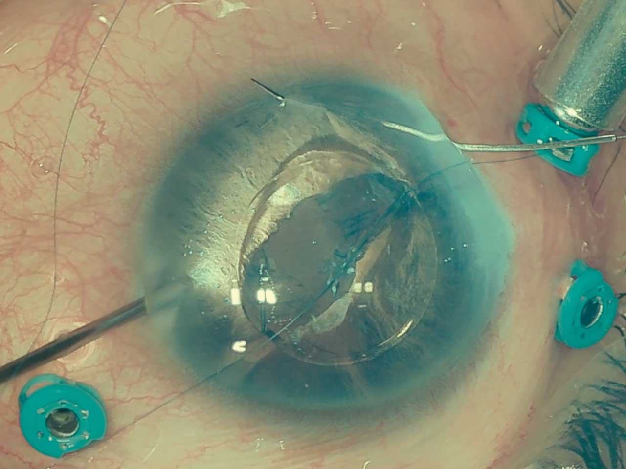 Figure 2.  Capture of the optic anterior to the iris to stabilize the intraocular lens during iris fixation with polypropelene sutures.