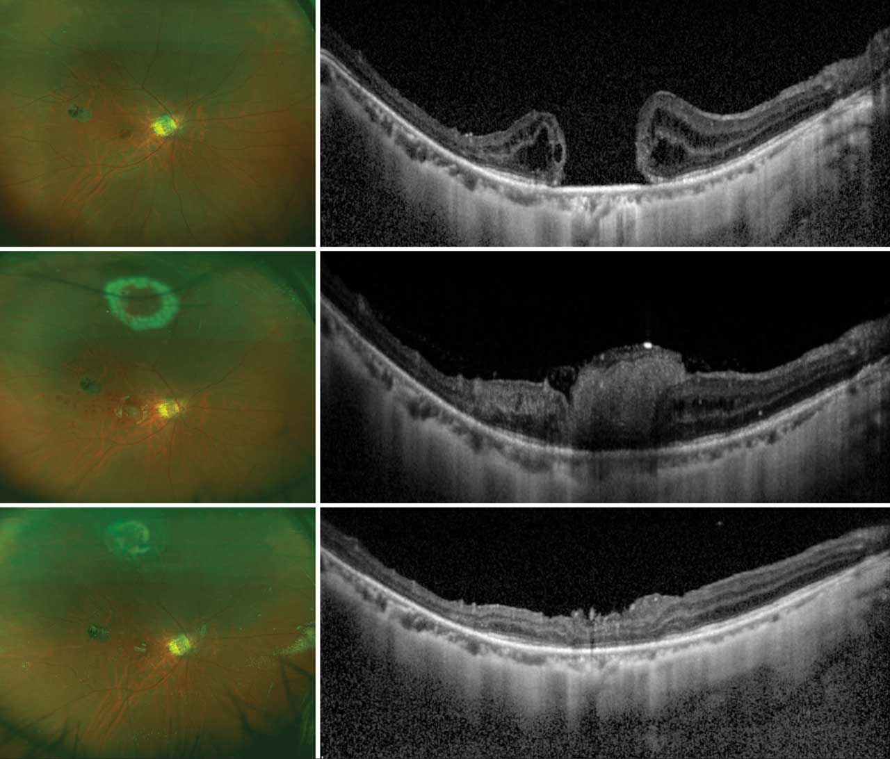 Figure 1. Anatomic closure following autologous retinal transplant. Preoperative image (A) of the large refractory myopic macular hole. Postoperative week 1 image (B) with hole closure, reconstitution of the ellipsoid zone, and alignment of the neurosensory layers between grafted peripheral retina and macular tissue.