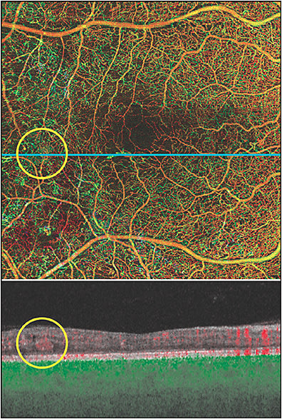 Figure 7. Swept-source optical coherence tomography angiography (Plex Elite 9000; Carl Zeiss Meditec) total retina slab of 12 mm x 12 mm scans showing suspended scattering particles in motion corresponding to the optical coherence tomography B scan (yellow circle).