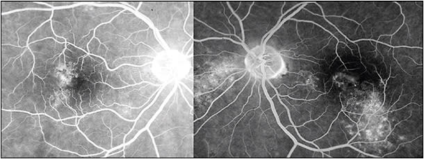 Figure 3. DRPE/chronic CSC (right eye and left eye) in a patient with Cushing syndrome. Note the leaks at the level of the RPE and RPE atrophic tracts (“gutters”) indicative of chronic leakage.