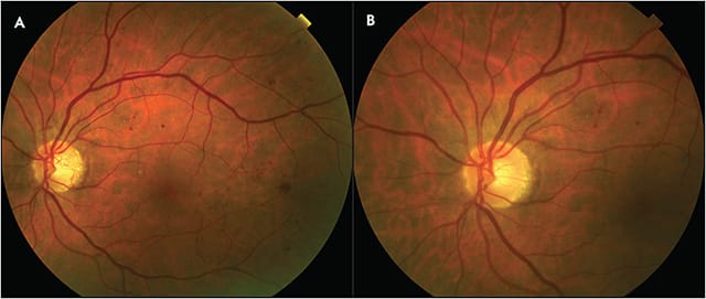 Figure 1. A fundus photo (Topcon) obtained prior to anti-VEGF therapy (A) shows retinal hemorrhages and neovascularization of the disc. A fundus photo (Topcon) obtained following treatment with several intravitreal anti-VEGF injections (B) shows less retinal hemorrhage as well as regression of neovascularization of the disc.