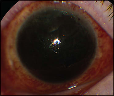 Figure 1. Eight-ball hyphema on the first postoperative day following an uncomplicated diabetic vitrectomy in a patient on dual antiplatelet therapy with aspirin and ticagrelor.