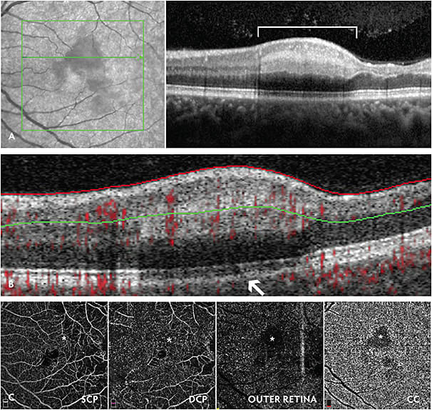 Figure 4. Optical coherence tomography and optical coherence tomography angiography (OCTA) in a patient with homozygous sickle cell disease who presents with acute-onset blurry vision. Visual acuity had decreased from 20/20 to 20/160. Optical coherence tomography (A) shows a hyper-reflective lesion at the level of the inner nuclear layer, consistent with paracentral acute middle maculopathy (white bracket). On OCTA (B), there is loss of choroidal perfusion (arrow) corresponding to the region of paracentral acute middle maculopathy. En face OCTA (C) shows minimal vascular changes (asterisk) in corresponding areas of the superficial capillary plexus (SCP) and deep capillary plexus (DCP). However, vascular density is reduced (asterisk) at the level of the choriocapillaris (CC).