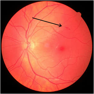 Figure 1. White-centered hemorrhage (arrow).