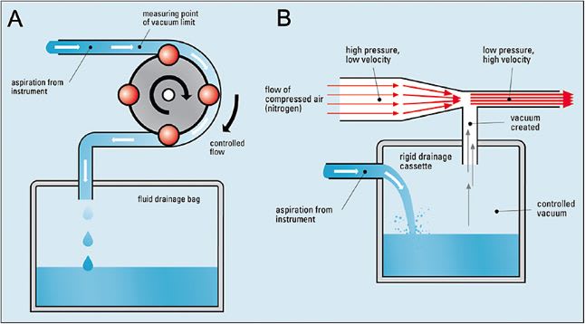 Figure 6. Comparison of Peristaltic pump (A) and Venturi pump (B). Image courtesy of Oertli Instruments