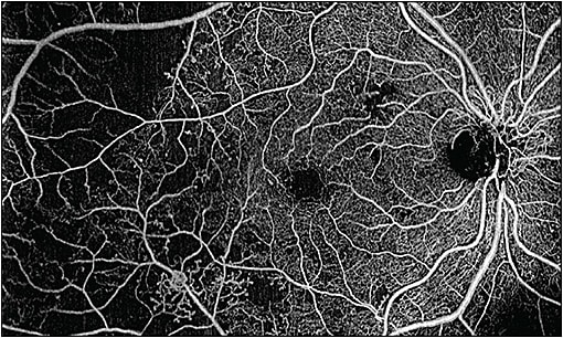 Figure 2. A 15 mm x 9 mm swept-source optical coherence tomography angiography image taken with the Zeiss Plex Elite 200 kHz.