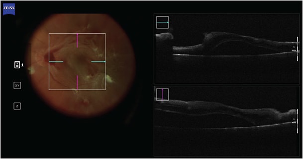 Figure 2. Intraoperative optical coherence tomography showed subhyaloid macular hemorrhage during a proliferative diabetic retinopathy case.