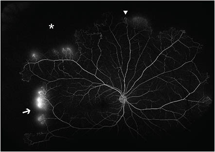 Figure 1. Ultrawidefield fluorescein angiography showing large areas of peripheral nonperfusion (asterisk), arteriovenous anastomoses (arrowhead) and sea-fan neovascularization (arrow) in a patient with homozygous sickle cell disease. Arteriovenous anastomoses can be differentiated from sea-fan neovascularization based on the presence of leakage in the latter.