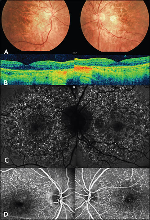 Figure 1. This 52-year-old female was referred with a 4 month history of progressive blurring of central vision and metamorphopsia from her left eye (LE). Visual acuity (VA) measured 20/20 both eyes (BE) and fundus examination revealed bilateral macular retinal pigment epithelial (RPE) mottling with patches of atrophy in the nasal macula (Figure A). Macular OCT demonstrated areas of outer retinal segment and RPE atrophy and fine sub-RPE drusen BE (Figure B). Fundus autofluorescence (FAF) vividly demonstrated innumerable, punctate hyperautofluorescent lesions significantly outnumbering the drusen noted clinically, which is characteristic for this disorder. There were also patches of hypoautofluorescence correlating to RPE atrophy (Figure C). With the aid of multimodal imaging, a diagnosis of cuticular drusen with RPE atrophy was made. In addition to the examples from this case, in another case, a classic appearance is depicted on fluorescein angiography (FA), on which these numerous punctate drusen stain discretely, resulting in a “stars-in-the-sky” appearance (Figure D)