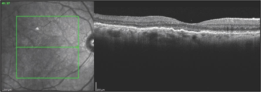 Figure 6. Resolution of retinal pigment epithelial detachment and subretinal fluid after combination photodynamic therapy (PDT) and bevacizumab 1.25 mg and dexamethasone 400 µg. Vision remained 20/40. This anatomic and visual improvement was maintained with good visual acuity and resolved edema and subretinal without further treatment for the rest of the patient’s life 6 years after combination PDT therapy.