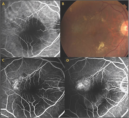 Figure 5. Treatment-naïve polypoidal choroidal vasculopathy (PCV) treated with combination photodynamic therapy with intravitreal bevacizumab 1.25 mg and dexamethasone 400 µg. Initial presentation of PCV with vascularized retinal pigment epithelial detachment (RPED) in right eye. Visual acuity is 20/60. Indocyanine green angiography revealed a branching vascular network and aneurysmal polypoidal lesions as part of a superotemporal polypoidal vascular complex adjacent to the hypofluorescent RPED (A). Color photo showing elevated RPED and inferonasal exudate (B). Early (C) and late (D) phase fluorescein angiogram showing occult hyperfluorescence superotemporally.