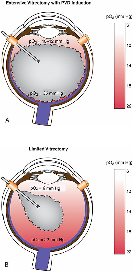 Figure 1. Extensive vitrectomy is associated with increased levels of retrolental oxygen that promotes cataract formation.9