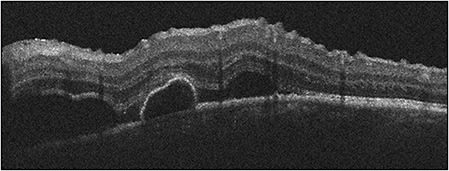 Figure 2. A young male presenting with septae on optical coherence tomography, consistent with Vogt-Koyanagi-Harada syndrome, that improved with oral steroid treatment.