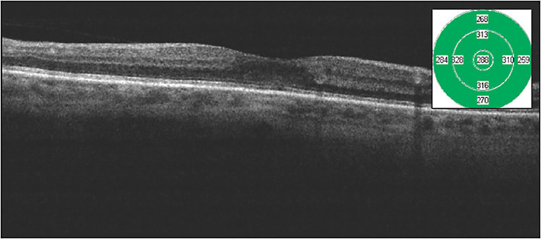 Figure 2. Spectral-domain optical coherence tomography 2 months after micropulse laser therapy in a 67-year-old white female who presented with moderate nonproliferative diabetic retinopathy and foveal involving macular edema with excellent vision. Imaging shows improved macular edema with central foveal thickness of 288 µm.