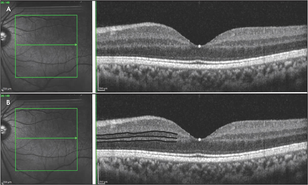 Figure 1. Spectral-domain OCT (Spectralis; Heidelberg Engineering) of a normal eye with laminations clearly identified and labeled (A). Spectral-domain OCT of the same patient highlighting the boundaries of the inner nuclear layer, outer plexiform layer, and the ganglion cell layer-inner plexiform layer complex (B).