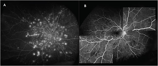 Figure 2. Infectious retinitis secondary to herpes-zoster virus, complicated by cicatrizing disease and rhegmatogenous retinal detachment (A). Fluorescein angiogram of a patient with toxoplasma chorioretinitis (B) compared to that of a patient with herpetic retinitis (C).