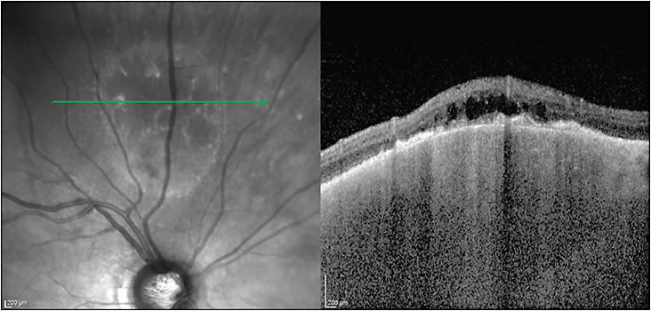 Figure 8. Standard OCT of a long-standing choroidal nevus revealing signs of chronicity, including retinal pigment epithelial disruption, outer retinal atrophy, and cystoid retinal edema.