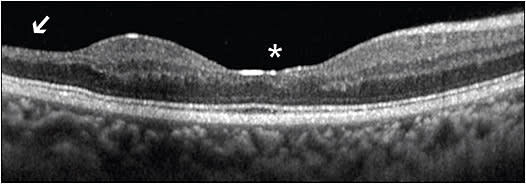 Figure 2. Spectral-domain optical coherence tomography demonstrates foveal splaying (asterisk) and temporal macular thinning (arrow) in a patient with hemoglobin S/O-Arab sickle cell disease. Hemoglobin O-Arab is a rare mutation in β-globin with a glutamine-to-lysine mutation in the 121st position.