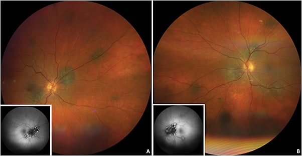 Figure 8. A 58-year-old male patient was referred for multiple choroidal pigmented lesions in both eyes
